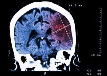 New study reveals ‘startling risk of stroke – TodayHeadline
