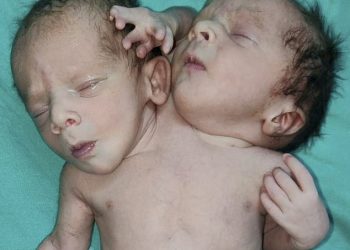 56004959 10668361 The miracle babies pictured have so far survived and have been a m 37 1648647269249 – TodayHeadline