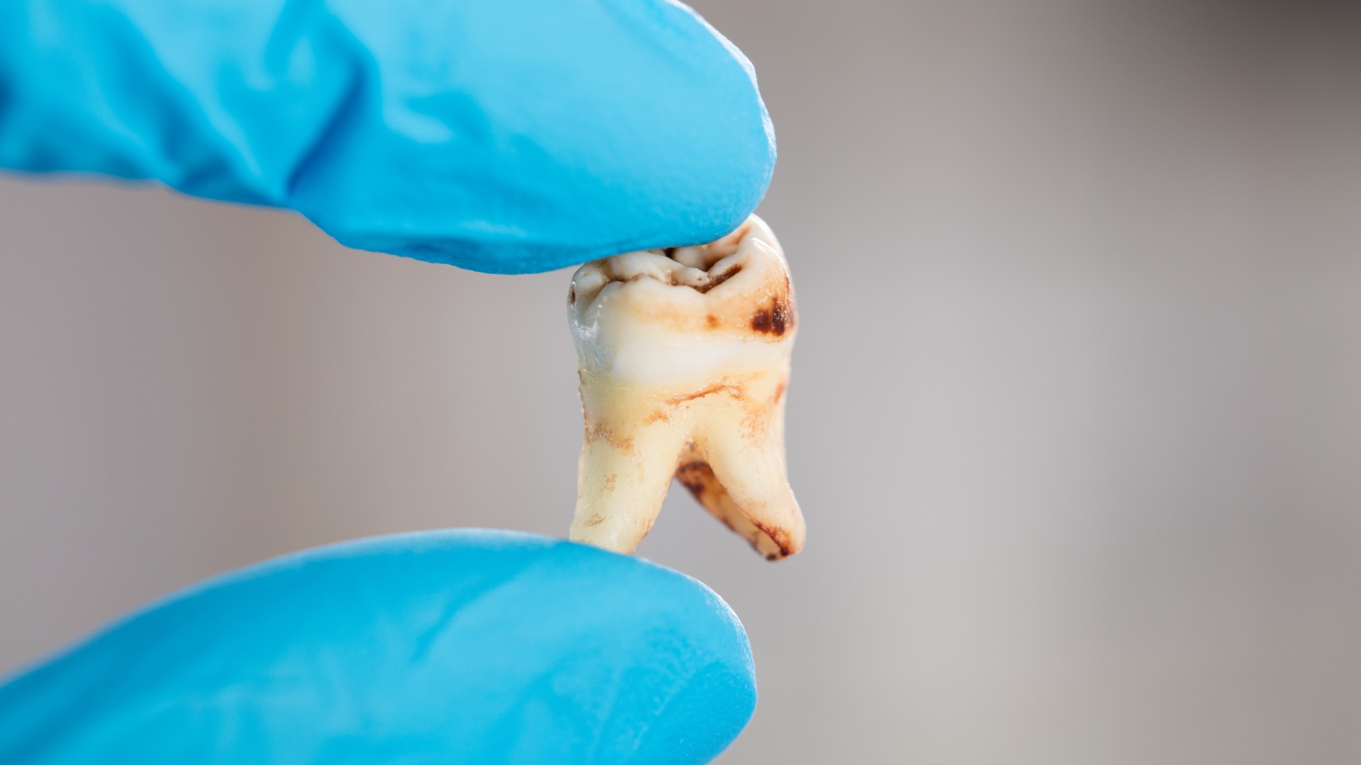 Close up of dentist hand in glove holding a decaying tooth (example of tooth decay).
