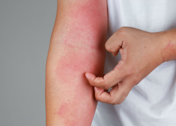 Eczema Arm Allergy Skin Concept jpg