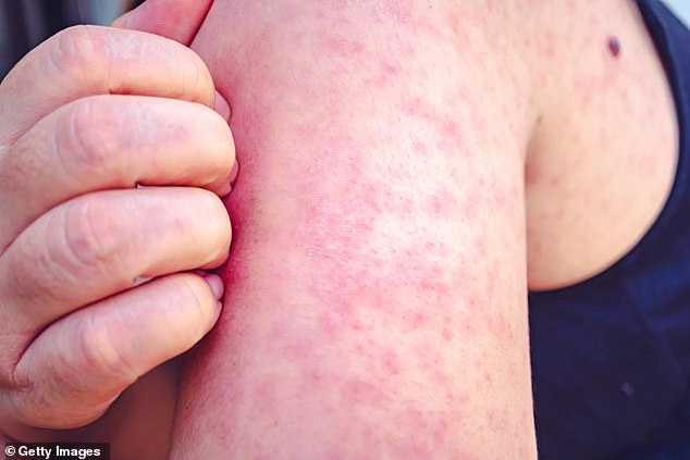 The measles symptoms YOU need to know about as jpg