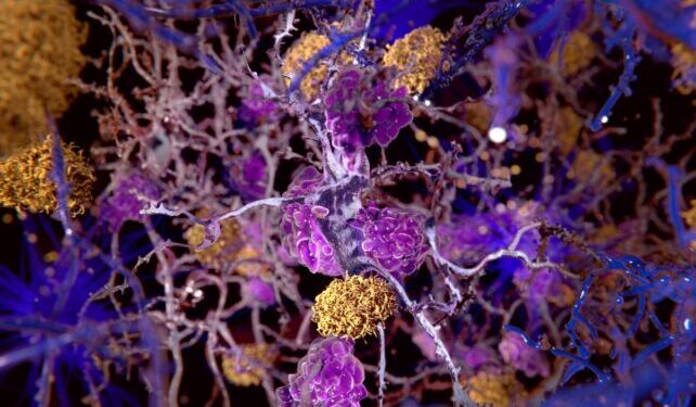 Clumps of yellow forming among purple neurons