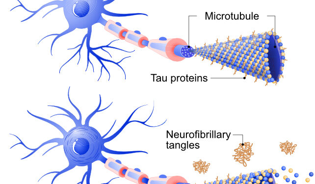 diagram of tau tangles in the brain