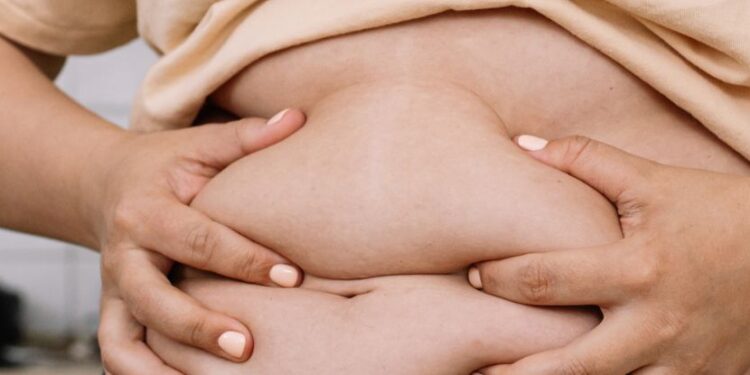 Fat Cells Seem to Cling to The Memory of Being Obese, Study Finds