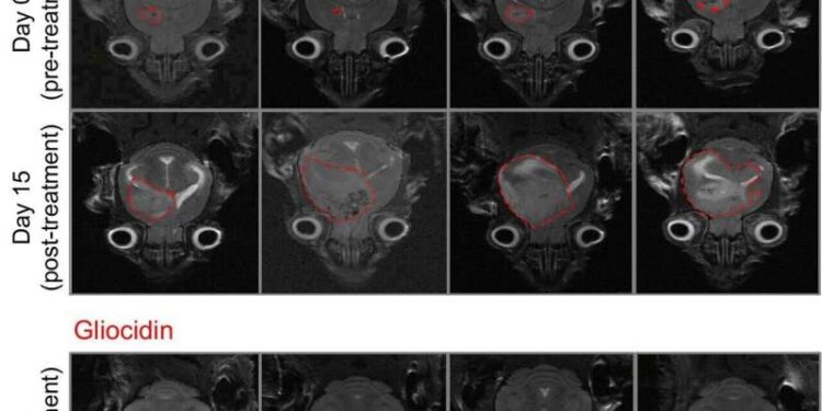 Glioblastoma treatment shows promise in mouse study