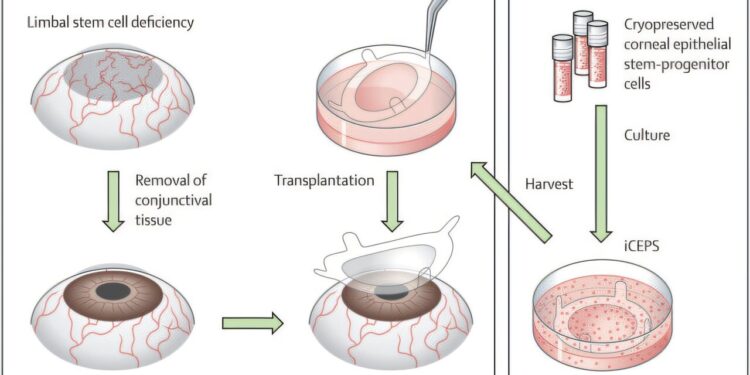 Human vision restored by stem cell replacement in regenerative medicine breakthrough