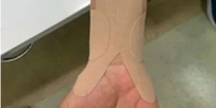 Kinesio taping may represent a new conservative therapy for some carpal tunnel patients