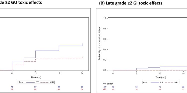 MRI-guided radiation therapy shown to reduce long-term side effects for patients with prostate cancer