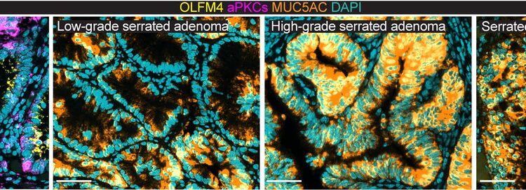 A four-panel image showing cells of a healthy intestinal mucosa (panel 1), premalignant adenoma gradually developing into a cancerous tumor (panel 2-4).