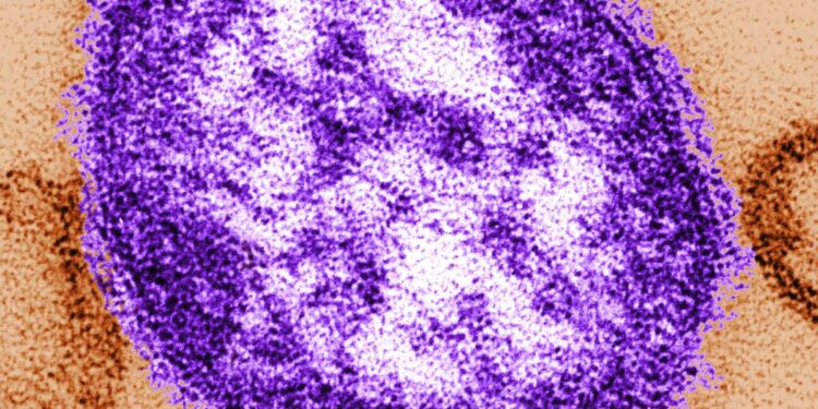 Measles case reported at LAX, Orange County children's hospital